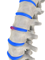 Natural Back Pain Relief